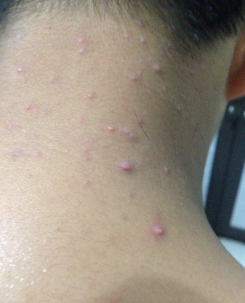 脖子上长痘痘的症状